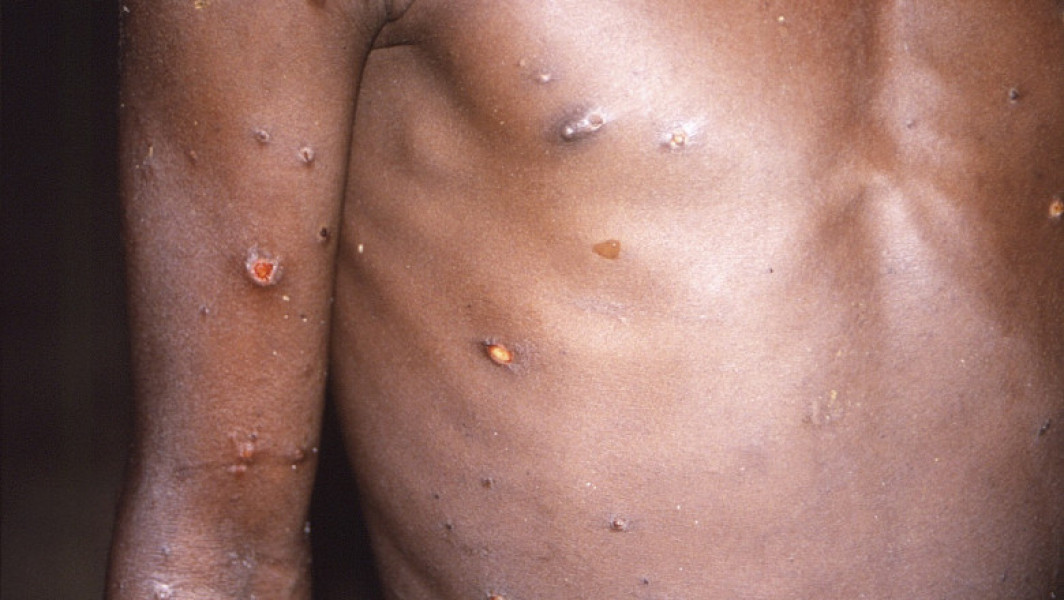 Mpox, declarată urgență de sănătate publică în Africa