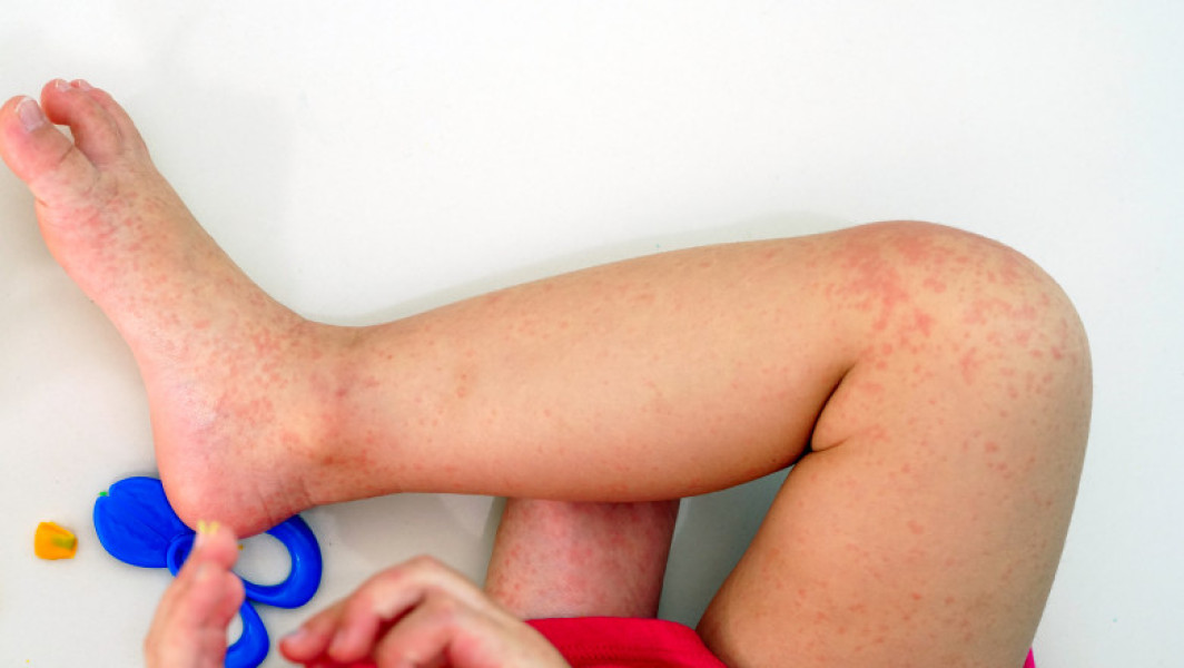Epidemia de rujeolă în continuă creştere în România: Ministrul Sănătăţii face un apel la vaccinarea copiilor şi adulţilor nevaccinaţi sau neimunizaţi!