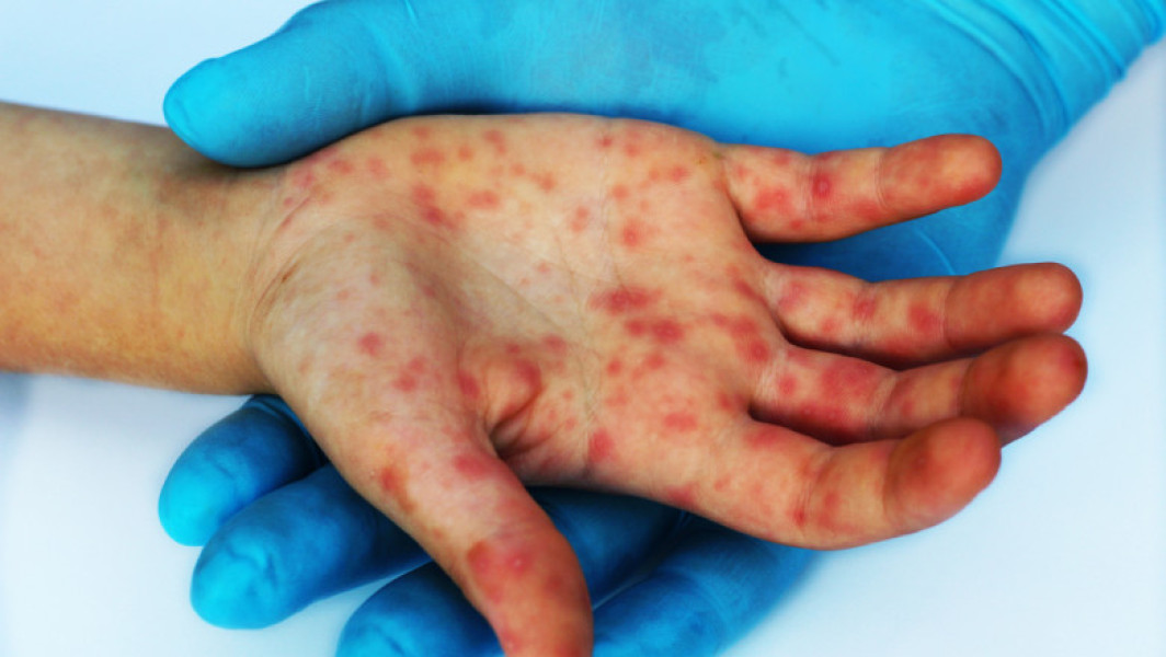Nevaccinarea unui copil de 2 ani duce la decesul său din cauza rujeolei. Situația este gravă: peste 15.000 de infectări și 16 decese raportate în România.